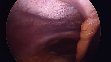 Laparoscopic TAP and Rectus Sheath Block