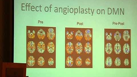Dr. Buracas talks about fMRI study results Part 2 - Hubbard Foundation 2011 CCSVI Conference