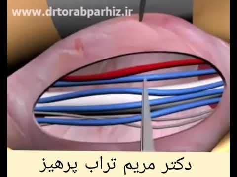 انیمیشنی درباره درمان زود انزالی