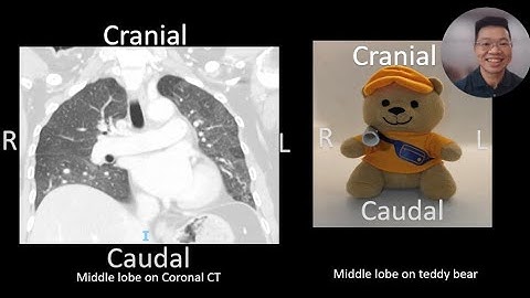 Airway mapping made easy! (Bronchial Branch Tracing) Middle Lobe