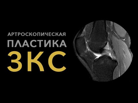 АРТРОСКОПИЧЕСКАЯ ПЛАСТИКА ЗАДНЕЙ КРЕСТООБРАЗНОЙ СВЯЗКИ (ЗКС)