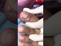 Ep_4703 Ingrown toenail removal 👣 มินิฮาร์ต ❤️ 😂 (clip from Thailand)