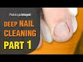 Deep nail cleaning [Part 1] Feet with hyperhidrosis #podologiaintegral