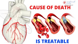 Heart Attack Symptoms And Angioplasty Treatment Animated Myocardial Infarction