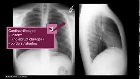 Lateral CXR  path part 2 - "EM in 5"