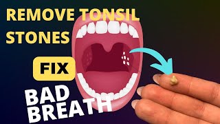 BAD Breath (Halitosis) - What CAUSES Tonsil Stones and  How to Treat and Prevent Them