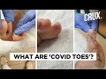 ‘Covid Toes’ Seen In Asymptomatic Patients of Coronavirus