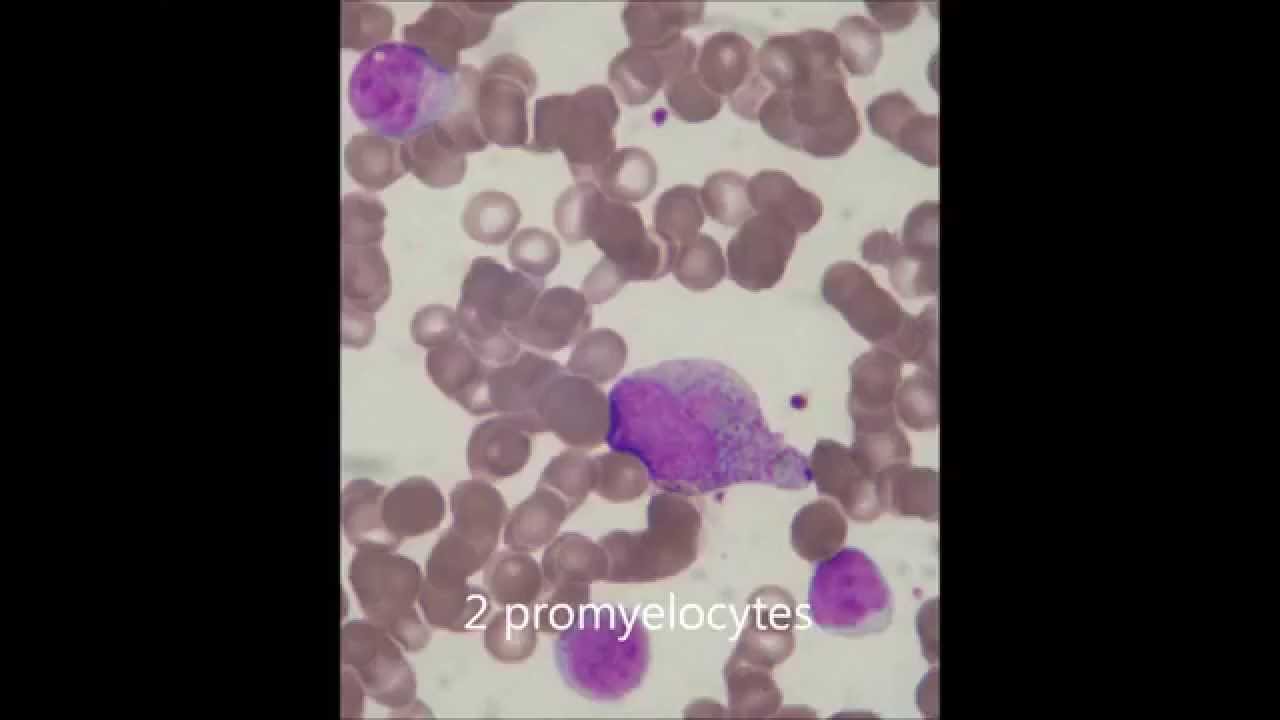 Kostmann syndrome - YouTube