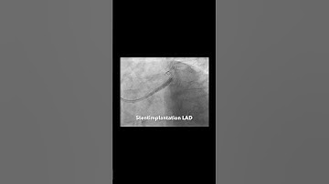 Unprotected left main bifurcation PCI using rotablation and DK-crush stenting technique #cathlab