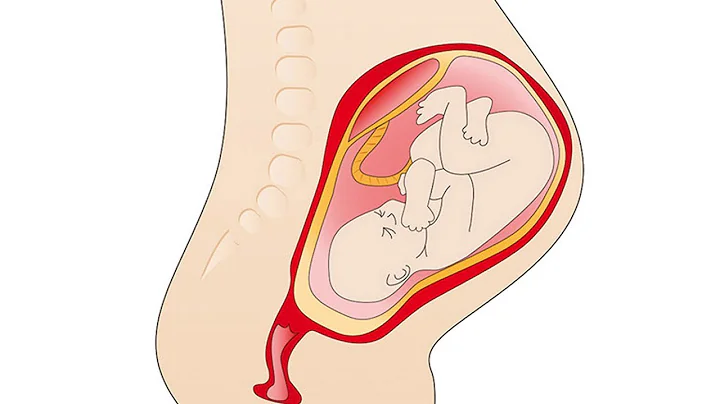 Placental Abruption - DayDayNews