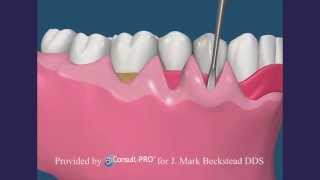 Soft Tissue Grafting - Mid-Peninsula Periodontics screenshot 5