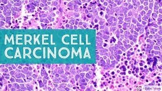 Merkel Cell Carcinoma 101 (primary cutaneous neuroendocrine carcinoma)