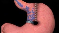 Vertical Banded Gastroplasty