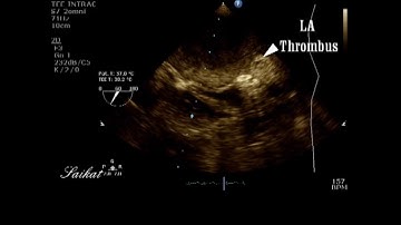 Dislodged LA appendage clot: You saved her from a massive embolic stroke
