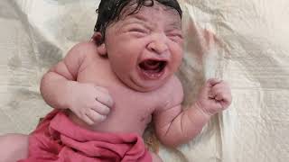 Special Newborn baby with Congenital anomalies just after birth #special