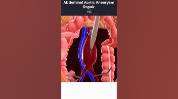 Abdominal Aortic Aneurysm Repair