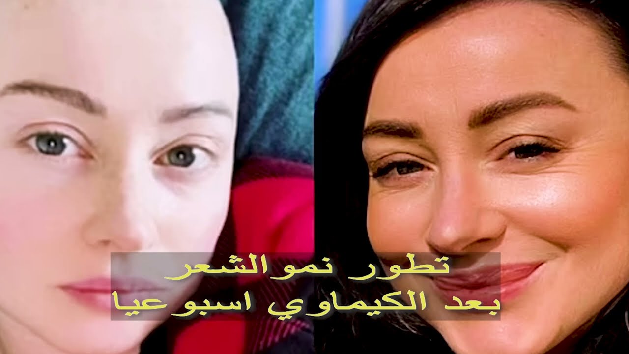 شاهد فرحة تطور نمو الشعراسبوعيا بعد الكيماوي لمريضه سرطان ثدي ❤️