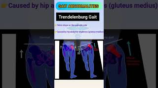 Gait Abnormalities
