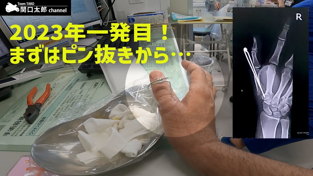 2022年最後のテスト（岡山）で転倒、骨折した指の「ピン抜き」。痛いけど見て。。
