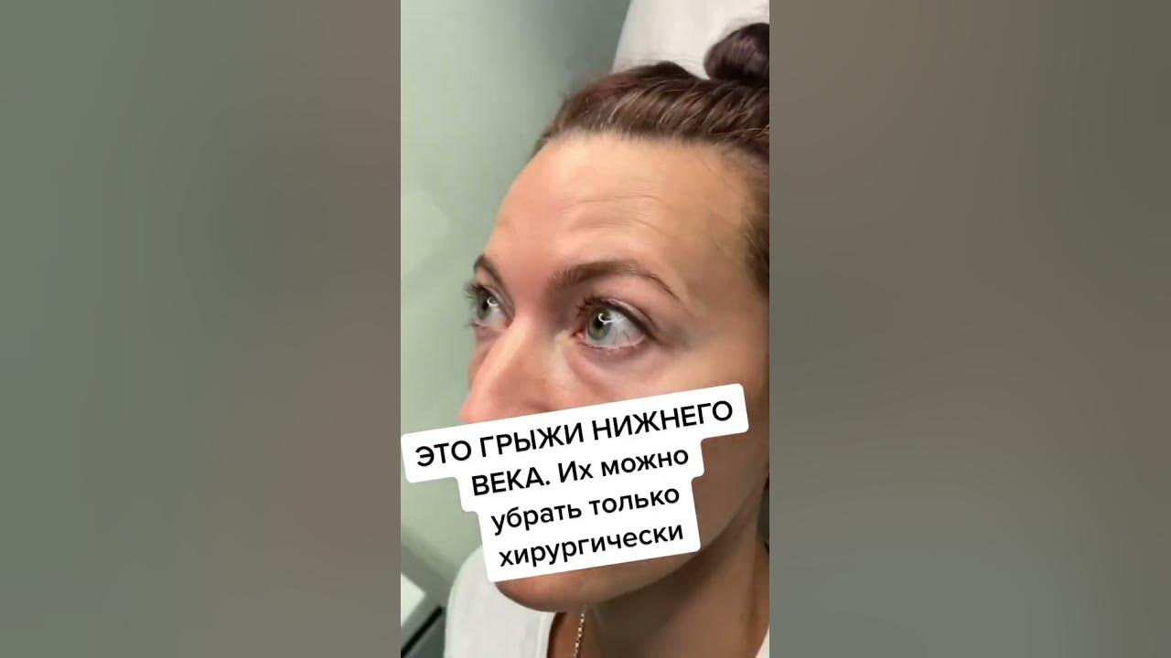 Это чаще генетическая особенность! У кого из твоей родни есть такое? 🙈# ...