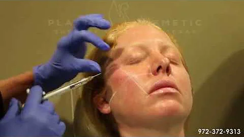 Facial Filler Injections - Featuring: Vicki McQueen
