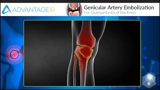 Lehetséges-e keményedni az artrózis esetén?, 3. szakasz a csípőízület deformáló artrózisa