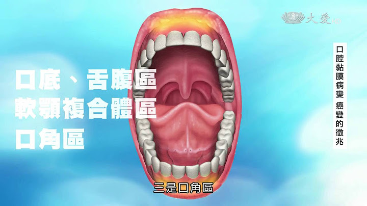 【口腔癌】口腔黏膜病變 癌變的徵兆 - 天天要聞