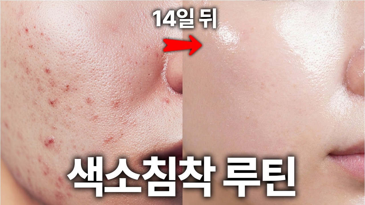 여드름 흔적, 유리컵 하나면 2주 만에 사라집니다