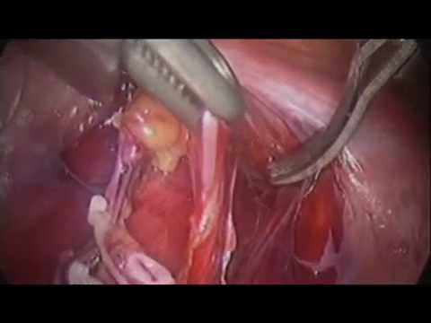 varicocelectomy laparoscopic bilateral cce