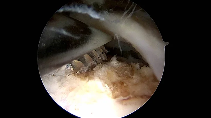 Rotator Cuff Repair Explained by a Phoenix Orthope...