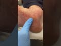 Ultimate Foot Satisfaction: Removing Callus in Arch of Foot #Podiatry #Satisfying