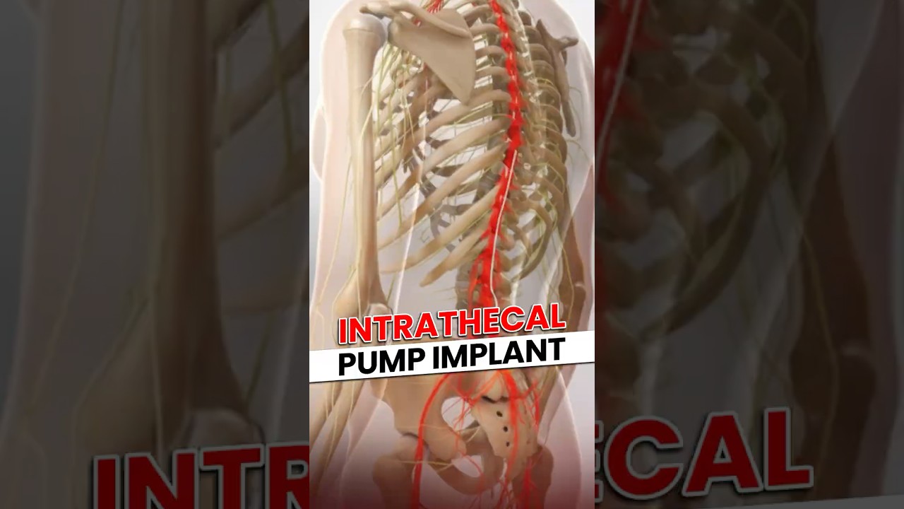 Intrathecal Pump Implant 