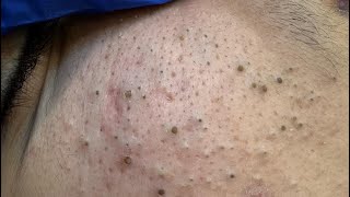 ASMR Korean Skincare Routine & Blackhead Extraction for Glowing Skin