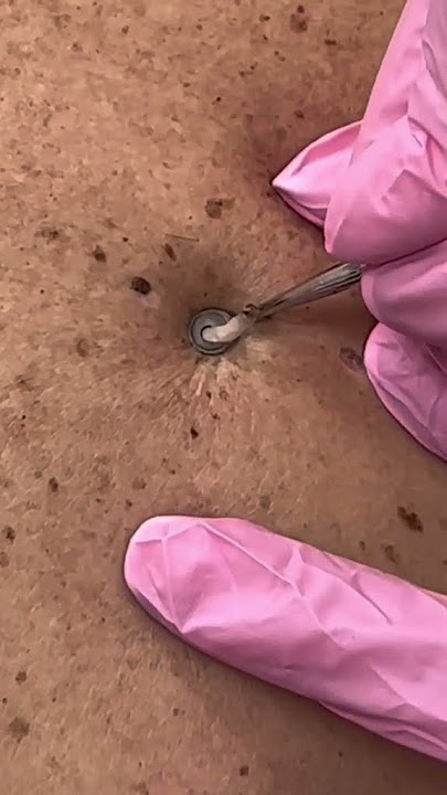 Blackhead removal