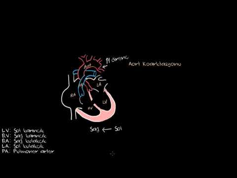 Video: Aortanın koarktasiyası siyanotikdirmi?