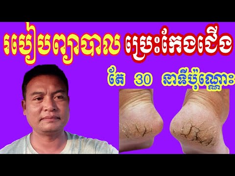 ថ្នាំបុរាណខ្មែរ : របៀបព្យាបាលប្រេះកែងជើង ប្រេះច្រើនប៉ុន្មានត្រឹមតែ30នាទីបាតជើងស្អាតដូចដើម។