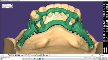 EXOCAD PARTIALCAD - PPR DIGITAL INFERIOR