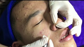Acne treatment for Loc Ha Long part 1 | Spa Linh Mun Acne Treatment
