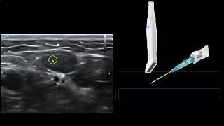 Ultrasound Guided IV Access