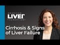 Progression of liver disease webcast series cirrhosis and signs of liver failure