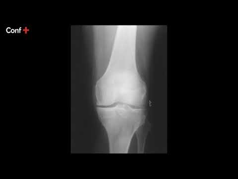 Vidéo: Arthrose De La Radiographie Du Genou