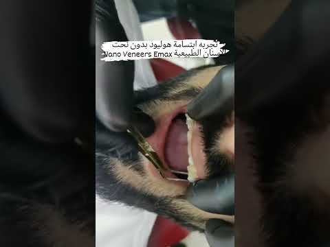 تجربه إبتسامه هوليود بتقنية النانو فينير ايماكس بدون حف للأسنان الطبيعية مع الدكتور عزضمان عشر سنوات