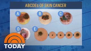 What to know about skin cancer: Selfexams, safety tips, more