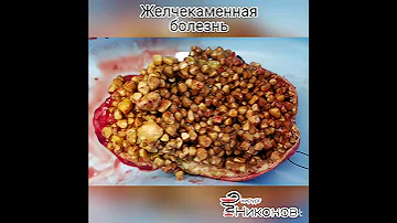 Удаление желчных камней. Лапароскопия желчного пузыря. Хирург Никонов в Алматы