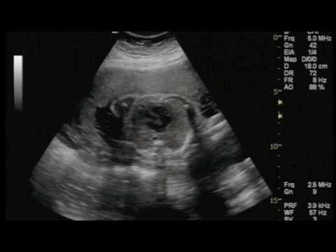 Gestacion A Los 7 Meses Imagui Gestacion A Los 7 Meses Imagui