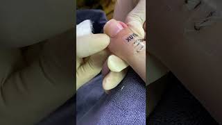 Satisfying ingrown toenail ex _66 - XUYEN CA MAU  #nail #nailart #nail2023