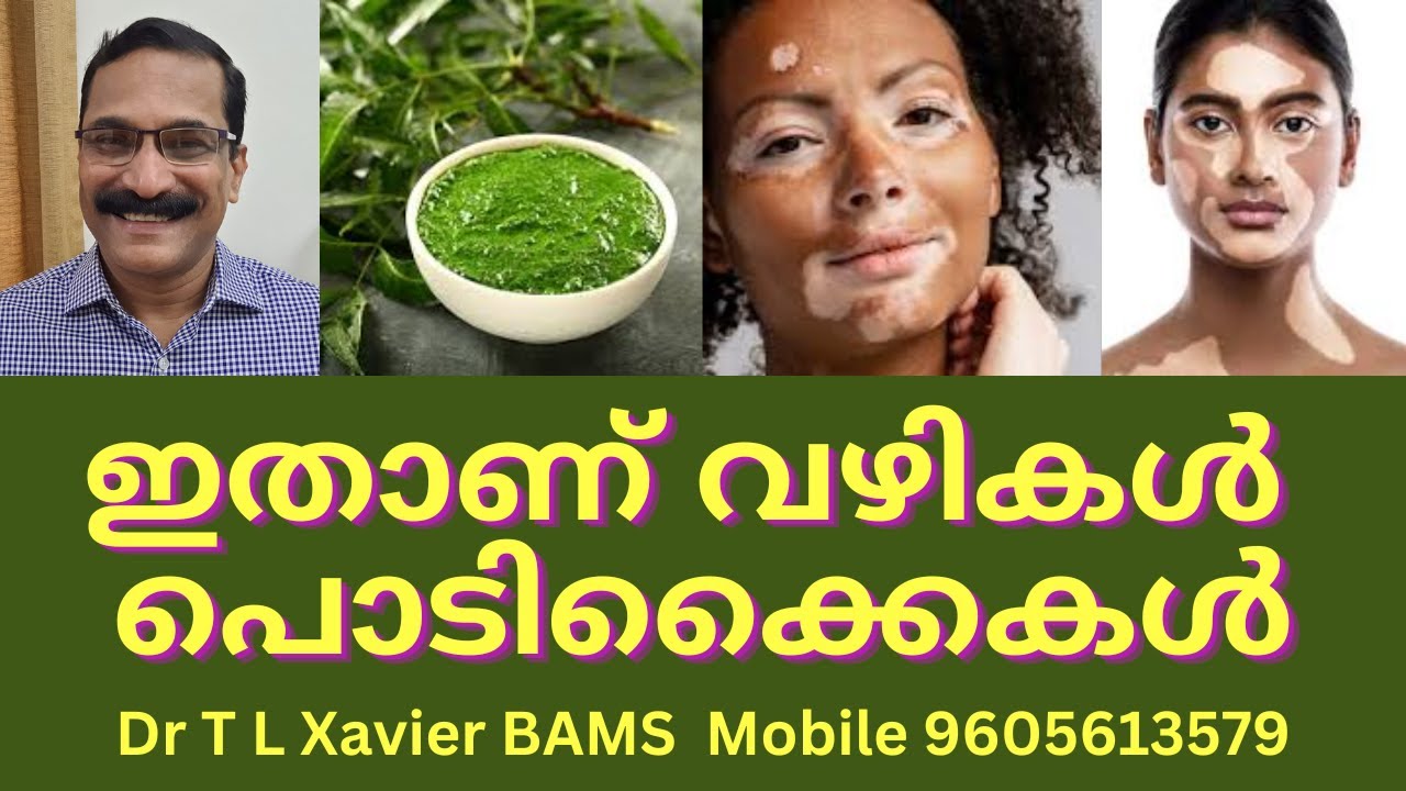 വെള്ളപാണ്ഡു | Vitiligo Relief: Discover Ayurvedic Home Remedies