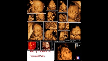 How To Get Perfect 3D/4D Baby Image By Ultrasonography System ( by Mindray )