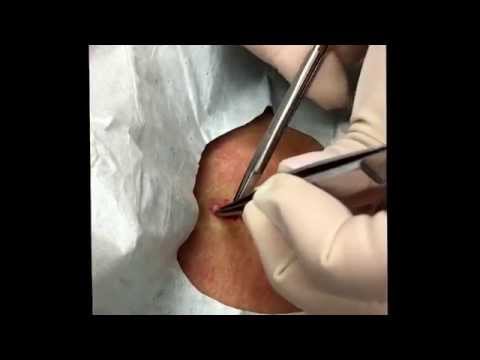 Cyst Excision On The Abdomen. A Clean One! For Medical Education- NSFE.
