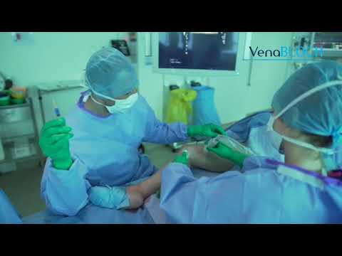 VenaBLOCK® for Perforator Veins